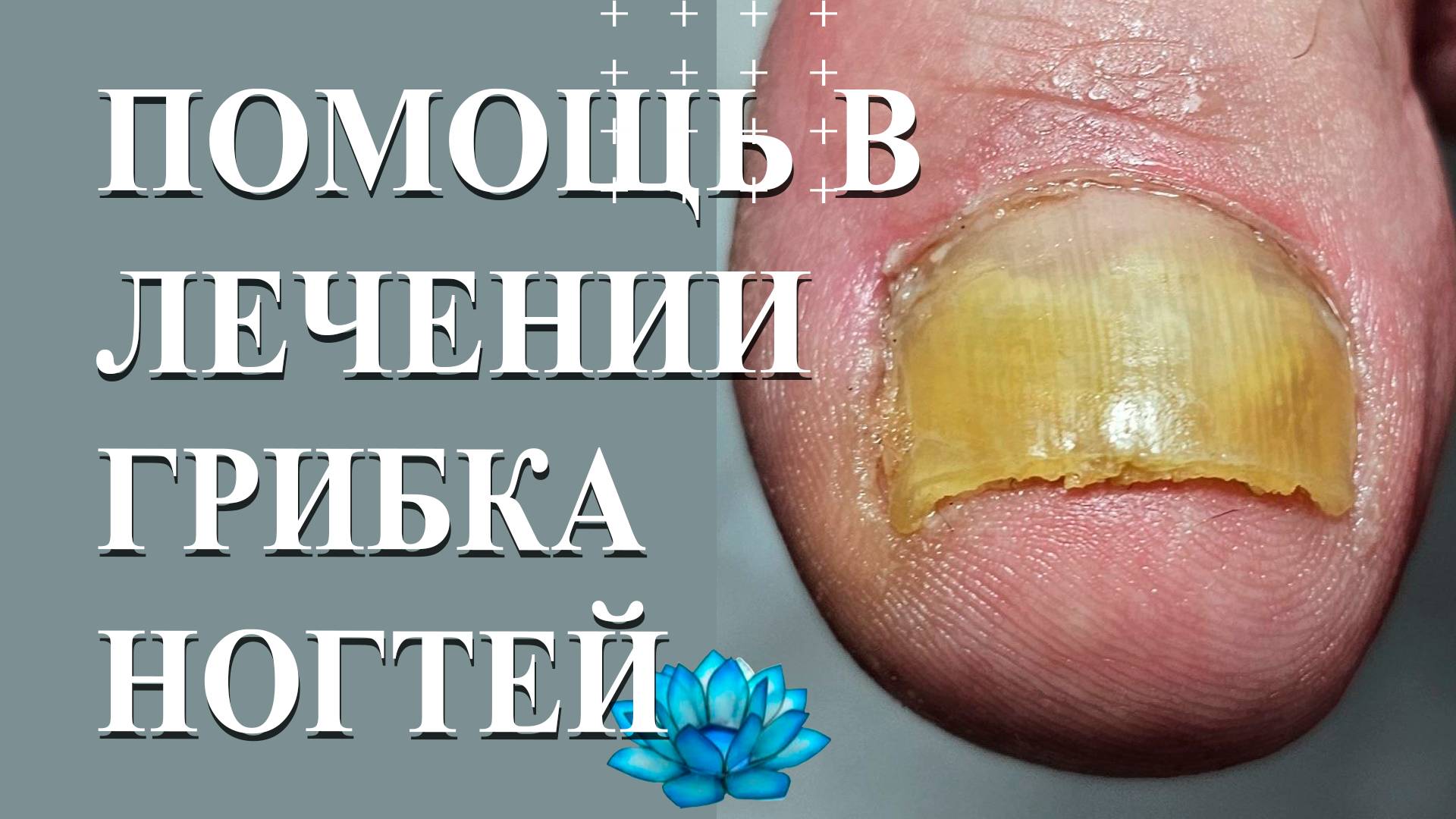 Как помочь клиенту вылечить грибок ногтей на ногах. смотреть онлайн