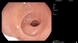 Гастроскопия +биопсия. Реальное видео. как делать? Как вводить гастроскоп?  Техника выполнения.