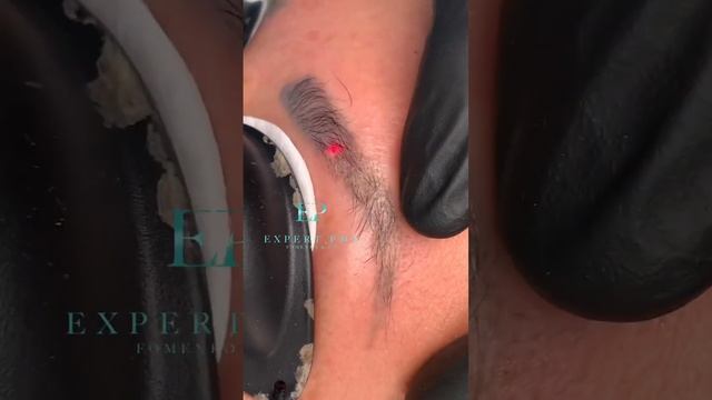 Лазерное удаление татуажа Москва #удалениетатуажа смотреть онлайн