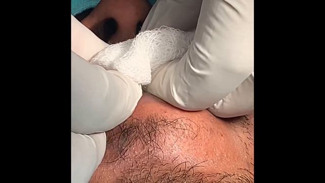 Smile designing by lip surgery смотреть онлайн
