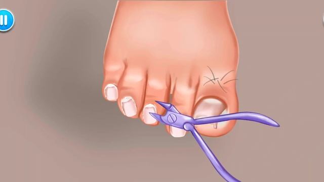 ASMR - Ingrown toenail , nails ? АСМР - Вросший ноготь , педикюр , уход за ногтями на ножках ? смотреть онлайн
