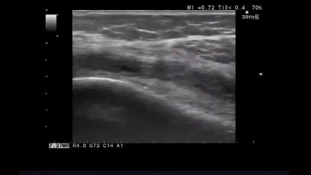 Выраженный гонартроз – изменения синовиальных оболочек. смотреть онлайн