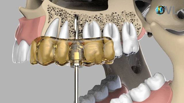 DVL шаблоны хирургические смотреть онлайн