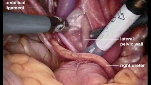 Robotic-Assisted Laparoscopic Extended Pelvic Lymph Node Dissection For Prostate Cancer смотреть онлайн