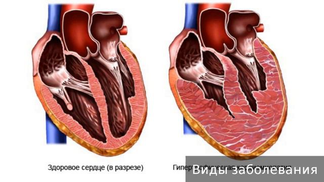 Кардиомегалия  Как лечить кардиомегалию