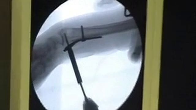 Остеосинтез перелома дистального эпиметафиза лучевой кости смотреть онлайн