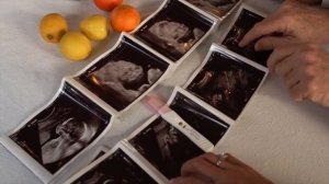 РОДЫ НА 25 НЕДЕЛЕ БЕРЕМЕННОСТИ | Какой прогноз если роды случатся раньше срока