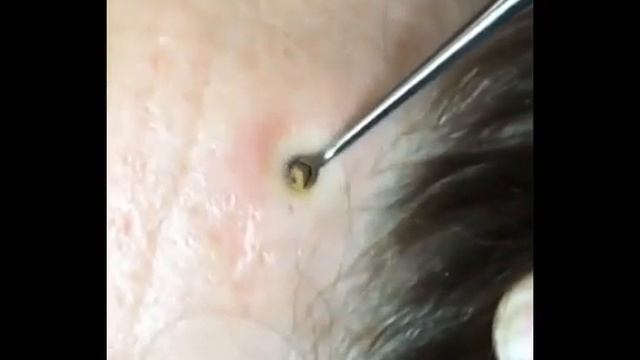 давят прыщи смотреть онлайн