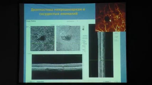 ОКТ-ангиография в оценке микрососудистых изменений сетчатки. Докладчик Охоцимская Т.Д. смотреть онлайн