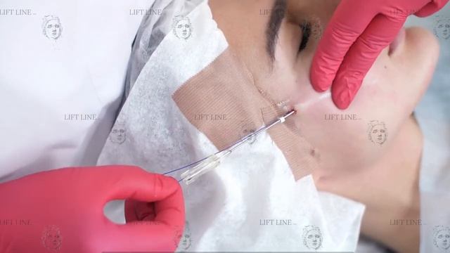 Подтяжка кожи лица нитями PDO Cog Lift Line Nata