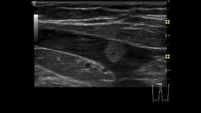 Шарик в вене