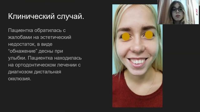 КЛИНИЧЕСКИЙ СЛУЧАЙ УСТРАНЕНИЯ ДЕСНЕВОЙ УЛЫБКИ РЕПОЗИЦИЕЙ ВЕРХНЕЙ ГУБЫ смотреть онлайн