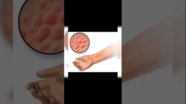 what is peanut allergies kya hote hai | kya peanuts dangerous hote hai | peanut allergies k lakshan смотреть онлайн