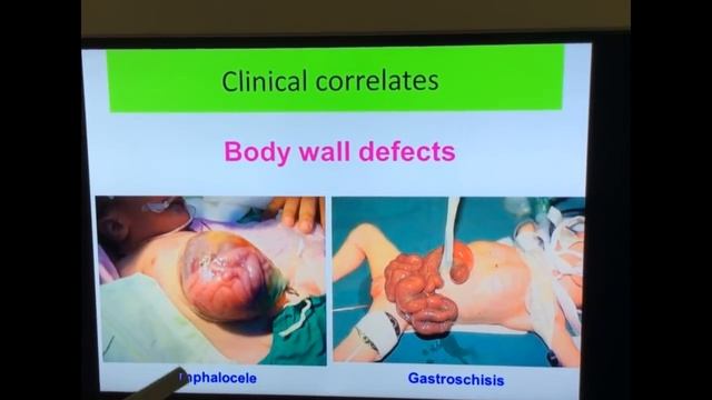 Embryology of GIT Part IV- Development of small and large intestine- Gut Rotation by Dr Vijaya смотреть онлайн