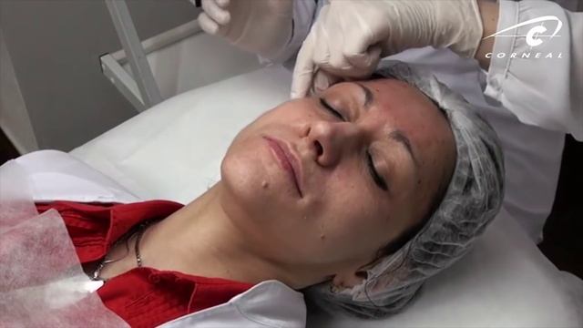 Биоревитализация против гусиных лапок! смотреть онлайн