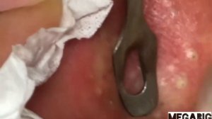 Много прыщей за ушами  Акне