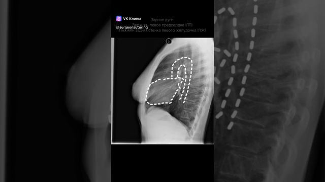 Сердце, левая боковая проекция.SurgeON #медицина #тренажер #рентген #кардиология #хирургия смотреть онлайн