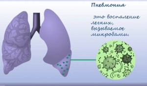 Пневмония. Причины, Симптомы и признаки, диагностика, лечение.