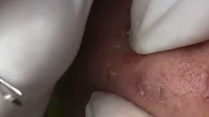 Новое. Чистка лица от черных точек. Удаление закрытых комедонов .