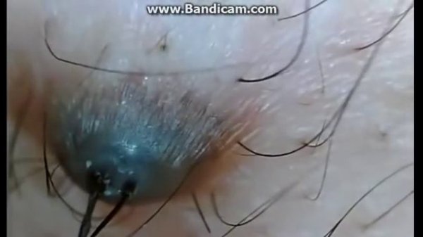 Вросшие волосы! Удаление!