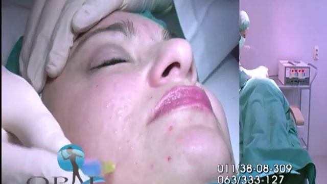 OPAL plasticna,rekonstruktivna i estetska hirurgija смотреть онлайн