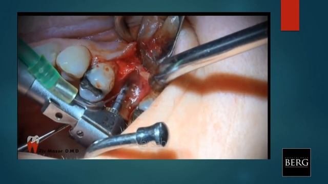 Paltop Webinars- Dr. Alejandro Berg - Sinus lifting techniques from A to DIVA part 3 смотреть онлайн