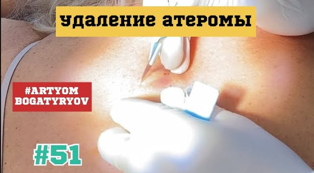 51. Плановое удаление атеромы спины