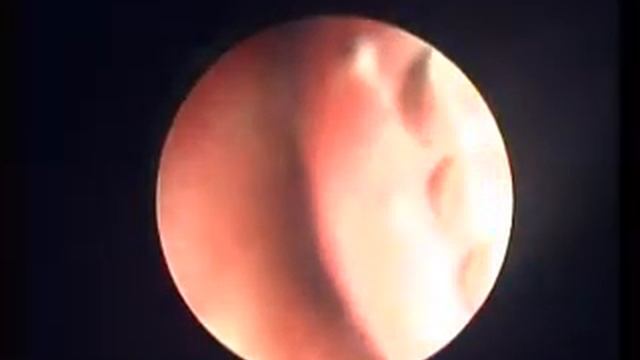 Видеоэндоскопический осомтр пациента с аденоидами 1 степени в больнице 