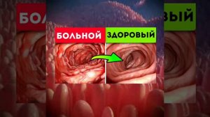 О дырявом кишечнике, информация  от специалиста.