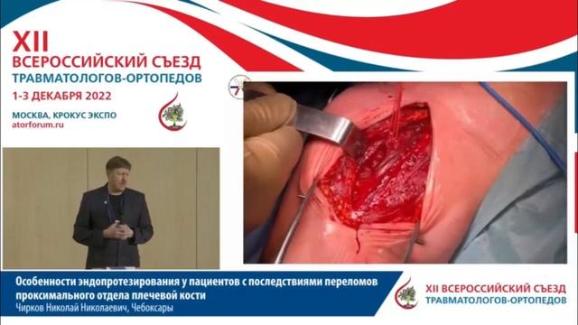 Особенности эндопротезирования у пациентов с последствиями переломов проксимального отдела плечев.. смотреть онлайн