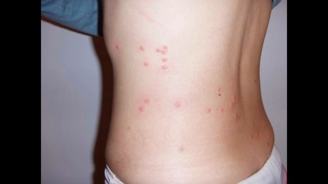 Как выглядят укусы постельных клопов? смотреть онлайн