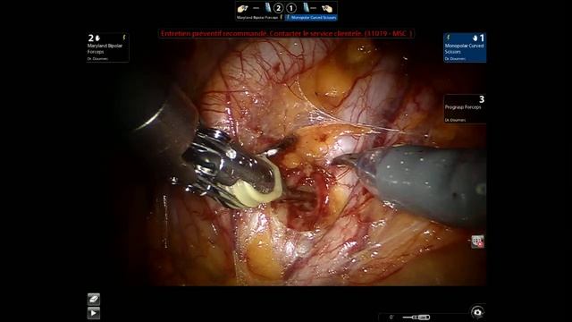 ROBOTIC EXTEND LYMPH NODE DISSECTION PART 1 SEMI LIVE NICOLAS DOUMERC смотреть онлайн