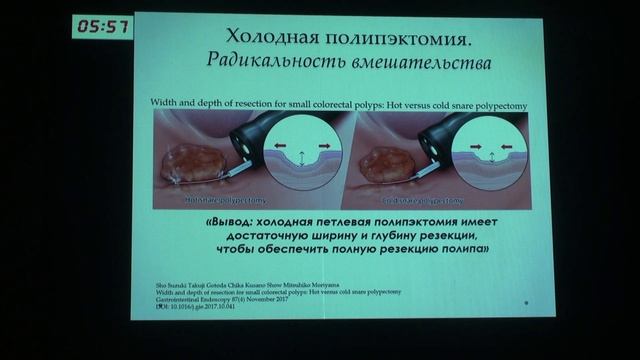 4 Агейкина Н.В. Холодная петлевая полипэктомия - неотъемлимая часть диагностической колоноскопии. смотреть онлайн