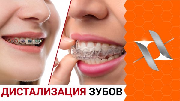 ДИСТАЛИЗАЦИЯ зубов в ортодонтии. Брекеты, элайнеры, аппараты.