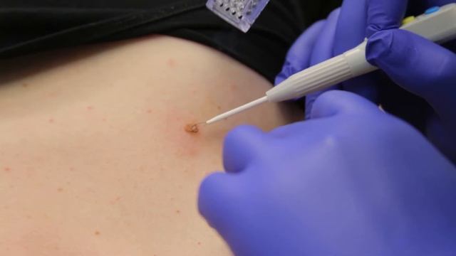 Удаление новообразований на аппарате Surgitron смотреть онлайн