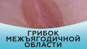 Грибок межъягодичной области.