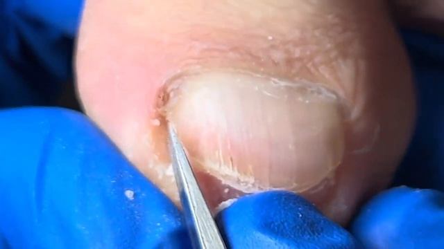 Nail Trimming: Ingrown Nails Make Walking Painful for Patients【Xue Yidao Pedicure】 смотреть онлайн