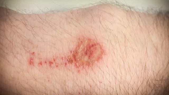 Ускоренный процесс заживление ссадины / Accelerated wound healing process смотреть онлайн