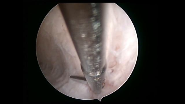 You Want Enjoy Fantastic Intaruterine Surgery, Uterine Septum By Osama Shawki