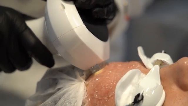 Фотоомоложение LUMECCA смотреть онлайн