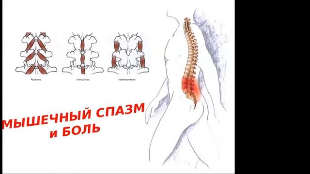 Здоровый позвоночник. Спину прихватило. смотреть онлайн