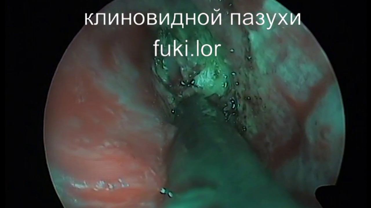 Киста клиновидной пазухи, лор-операция, ЛОР-хирург Фуки Е.М., к.м.н., врач высшей категории Fuki.lor