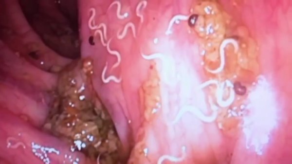 Паразиты в организме человека: симптомы,признаки,лечение,профилактика глистов,очищение от паразитов