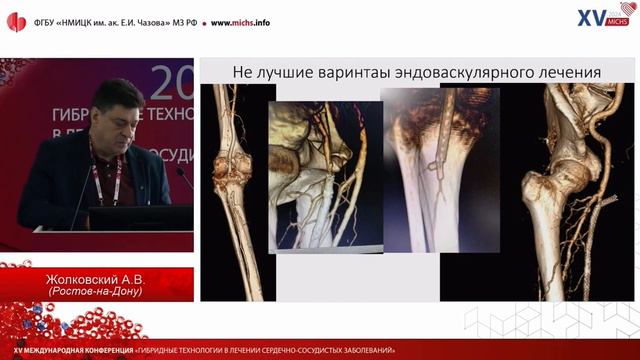 Жолковский А.В.- MICHS 2024 “Тех-кие решения, обеспеч-щие возникновение осложнений у сос. больных.. смотреть онлайн