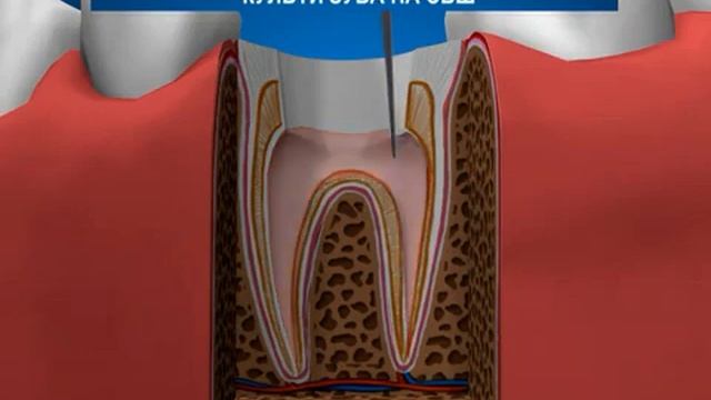 Пломбирование корневых каналов и восстановление культи зуба на свш смотреть онлайн