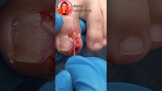 Пришла после хирурга / Врос ноготь на ноге что делать? Как удалить вросший ноготь? #nails #shorts смотреть онлайн