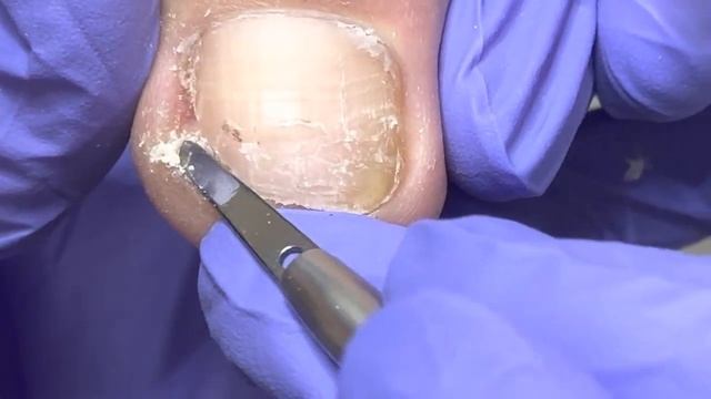 The second stage of paronychia treatment, using wire to fix the nails【Doctor Liu Pedicure】 смотреть онлайн