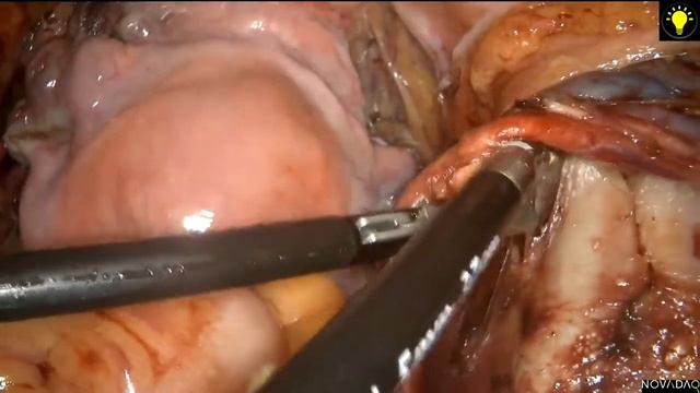 Laparoscopic Surgical Staging for early stage endometrial cancer with sentinel lymph node mapping смотреть онлайн