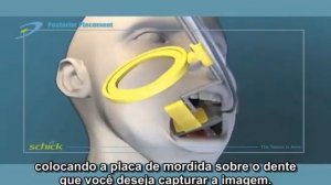 Применение позиционеров интраоральных в стоматологической практике