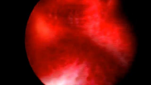 Непроходимость маточных труб смотреть онлайн